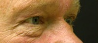 Blepharoplasty