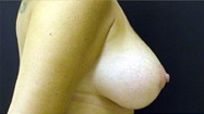 Breast Lift