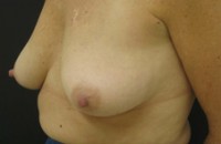 Breast Lift