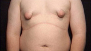 Gynecomastia Case 4025 Before Photo Gynecomastia