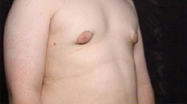 Gynecomastia Case 4025 After Photo Gynecomastia