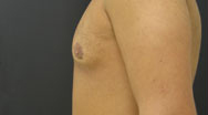 Gynecomastia Case 4059 After Photo Gynecomastia