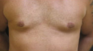 Gynecomastia