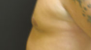 Gynecomastia