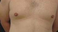 Gynecomastia Case 4079 Before Photo Gynecomastia