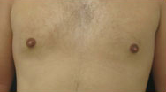 Gynecomastia