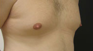 Gynecomastia Case 4079 Before Photo Gynecomastia