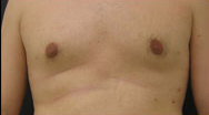 Gynecomastia