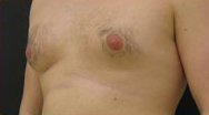 Gynecomastia