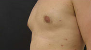 Gynecomastia