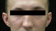 Otoplasty Case 3028 Before Photo Otoplasty
