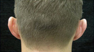 Otoplasty Case 3028 Before Photo Otoplasty