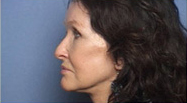 Facelift Case 3068 After Photo Facelift