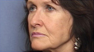 Facelift Case 3068 Before Photo Facelift