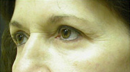 Brow Lift Case 454545 Before Photo Brow Lift
