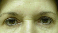 Brow Lift Case 454545 Before Photo Brow Lift