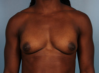 Breast Augmentation