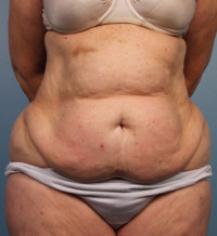 Abdominoplasty Before & After Gallery