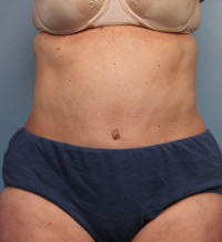 Abdominoplasty Before & After Gallery