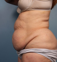 Abdominoplasty Before & After Gallery