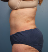 Abdominoplasty Before & After Gallery