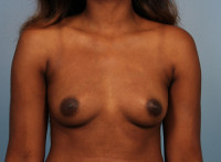 Breast Augmentation