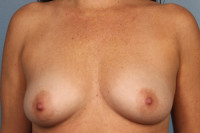 Breast Augmentation