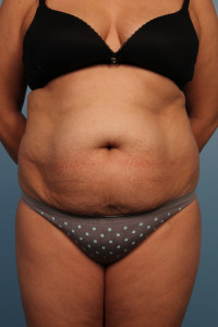 Abdominoplasty