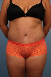 Abdominoplasty