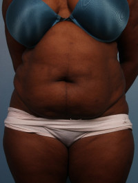 Abdominoplasty