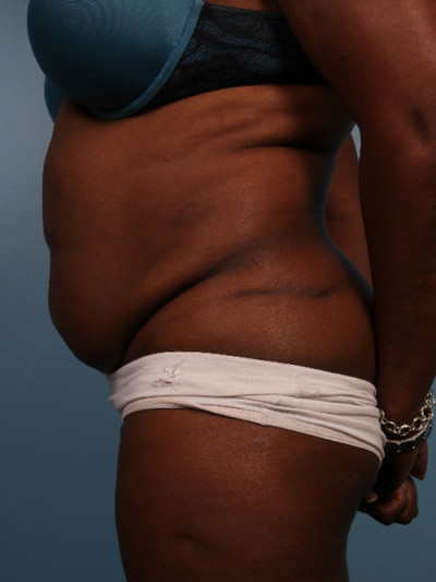 Abdominoplasty Case 5502 Before Photo Abdominoplasty
