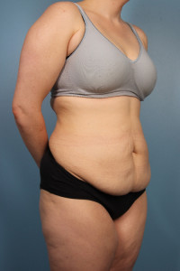 Abdominoplasty