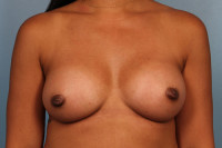 Breast Augmentation