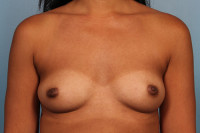 Breast Augmentation