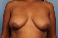 Breast Augmentation