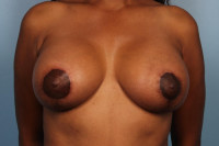 Breast Augmentation