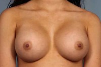 Breast Augmentation