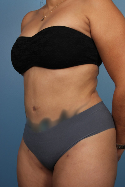 Abdominoplasty