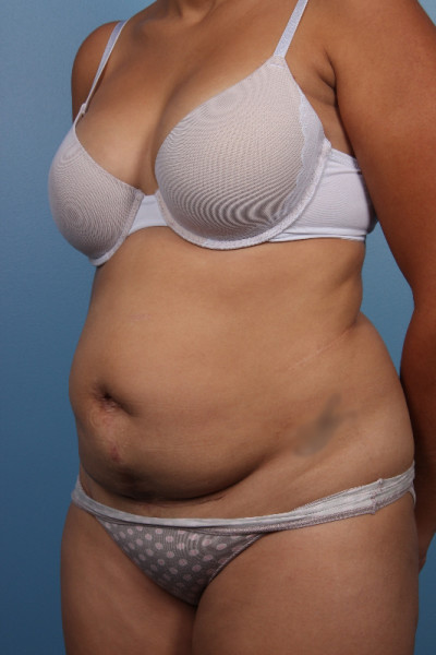 Abdominoplasty