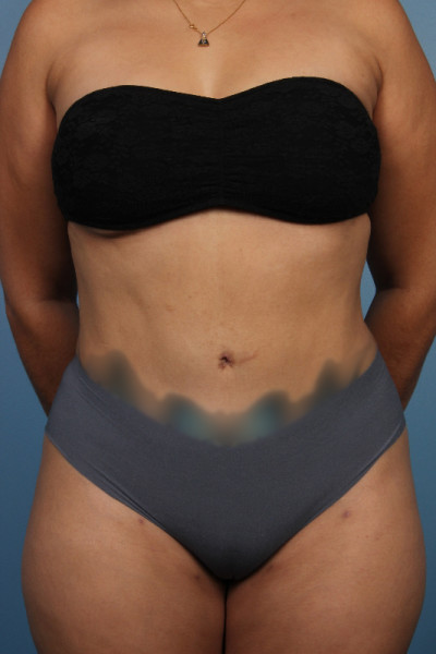 Abdominoplasty