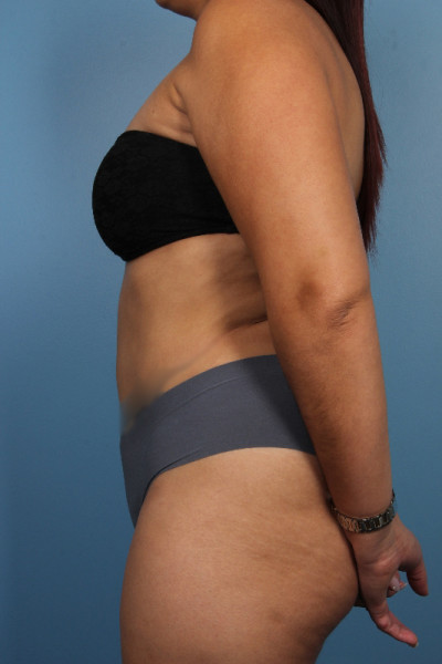 Abdominoplasty