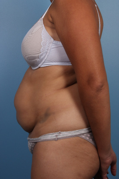 Abdominoplasty