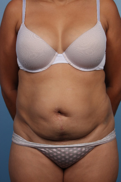 Abdominoplasty