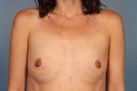 Breast Augmentation