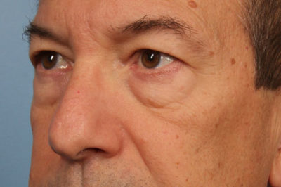 Blepharoplasty Case 6222 Before Photo Blepharoplasty