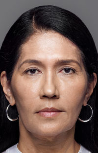 Revance Filler