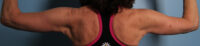 Brachioplasty