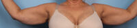 Brachioplasty