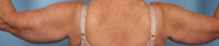 Brachioplasty