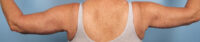 Brachioplasty